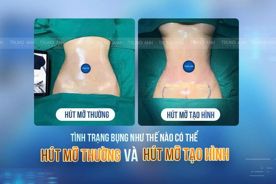 Tình trạng bụng nào có thể hút mỡ thường và hút mỡ tạo hình