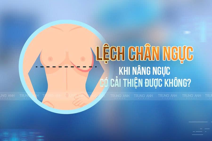 Lệch chân ngực khi nâng ngực có cải thiện được không?