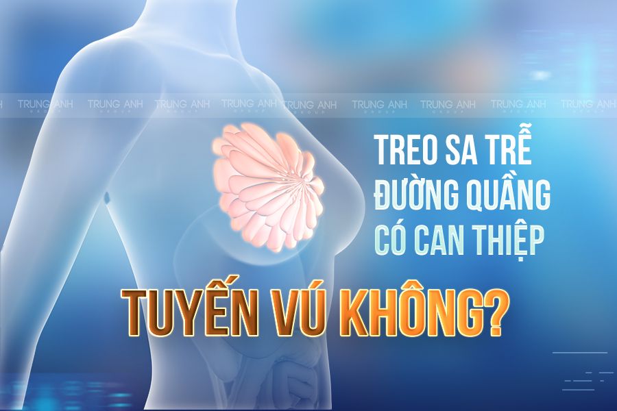 Treo sa trễ đường quầng có can thiệp tuyến vú không?